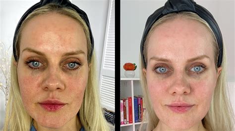 face roller results|dermaroller neck before and after.
